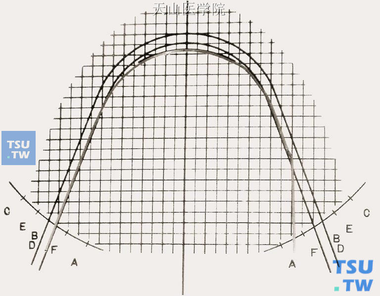 比对弓形图版，弓丝从E点回弯到F点，或与牙弓中线平行，完成磨牙外展弯