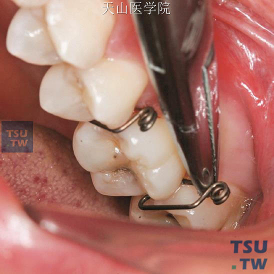 持针器夹持分牙簧短臂，在左上第一磨牙远中放置分牙簧