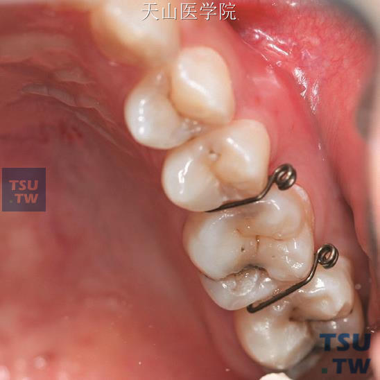左上第一磨牙近远中应用分牙簧（牙合面观）