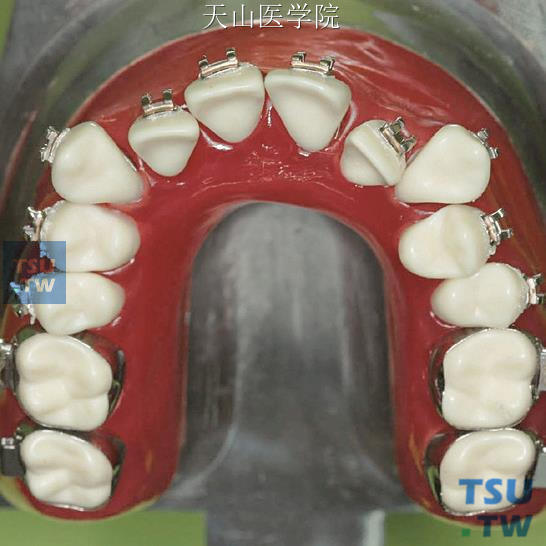 矫治前模型（上颌牙合面像）