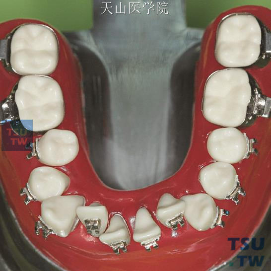 矫治前模型（下颌牙合面像）
