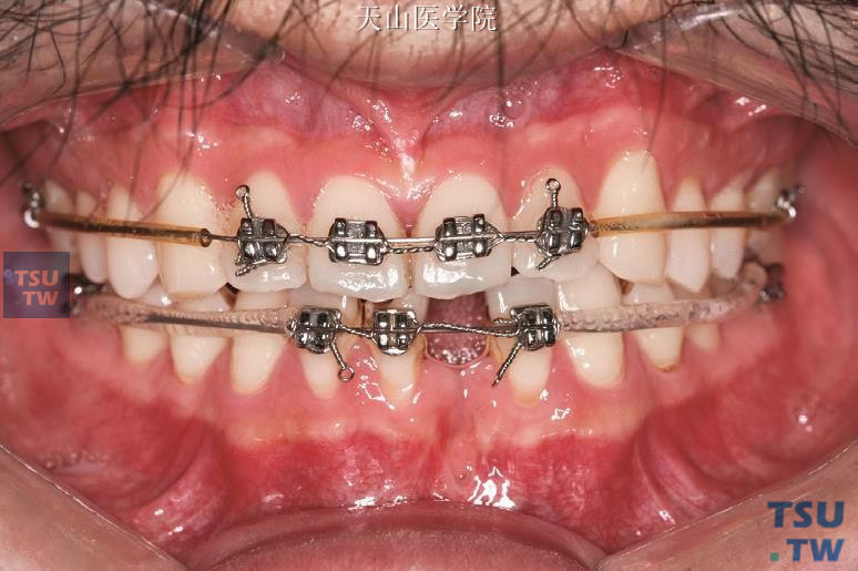 前牙反牙合解除后，应用带欧米茄曲的上颌弓丝维持牙弓长度（正面牙合像）