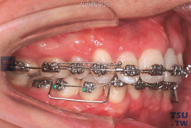 临床病例应用多用途弓（右侧牙合像）
