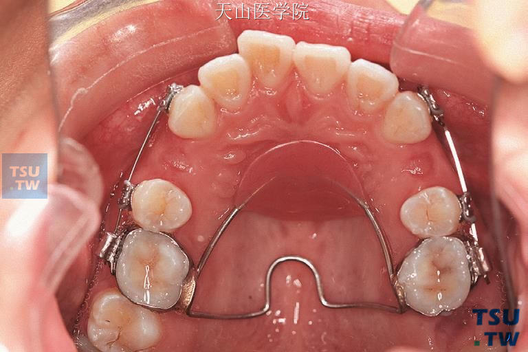 临床病例应用靴形曲拉尖牙向后时增强后牙支抗（上牙合面像）
