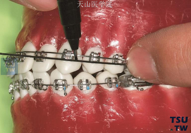 弓丝与唇弓平行，在第一前磨牙近中3mm、近尖牙托槽远中处作标记