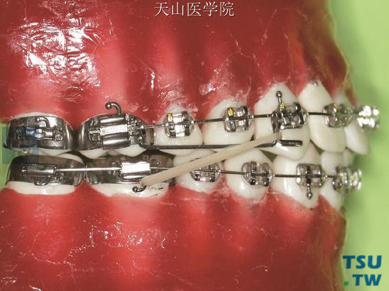 滑动杆配合Ⅱ类牵引推上颌磨牙向远中（右侧牙合像）
