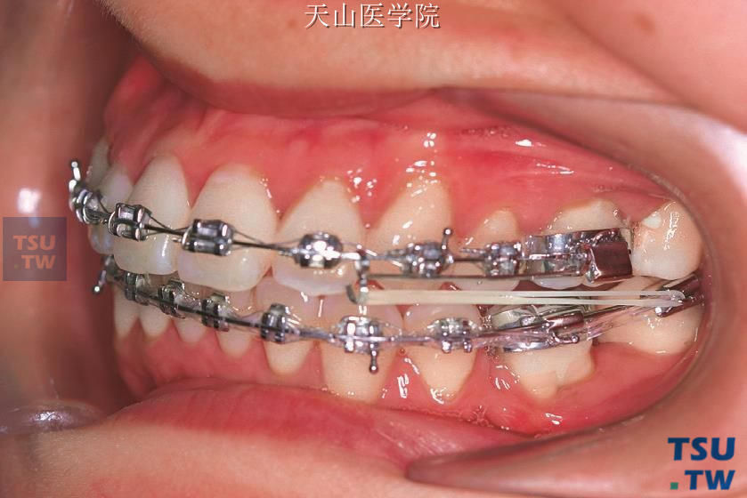 配合Ⅱ类牵引推上颌磨牙向远中（左侧牙合像）