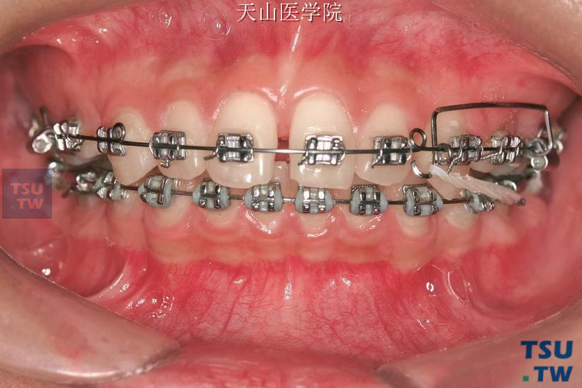 上颌弯制滑动杆，配合Ⅱ类牵引推上颌磨牙向远中（正位牙合像）