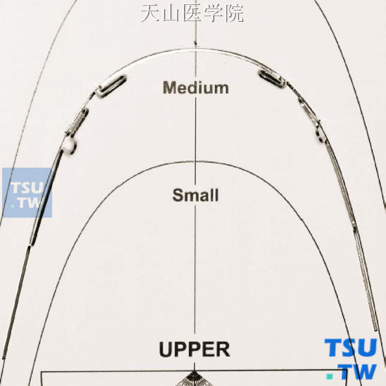 推磨牙变异MEAW弓丝：弯制完成的上颌变异MEAW曲弓丝具有标准弓形