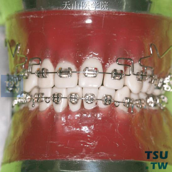 推磨牙变异MEAW弓丝：双侧加力后的上颌MEOW曲弓丝前牙段入槽时的情形（正面观）