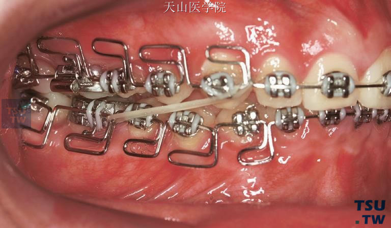 深覆牙合患者戴用反向MEAW弓丝的右侧牙合像