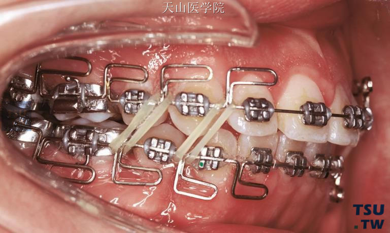 患者戴用精细调整用的MEAW弓丝的右侧牙合像