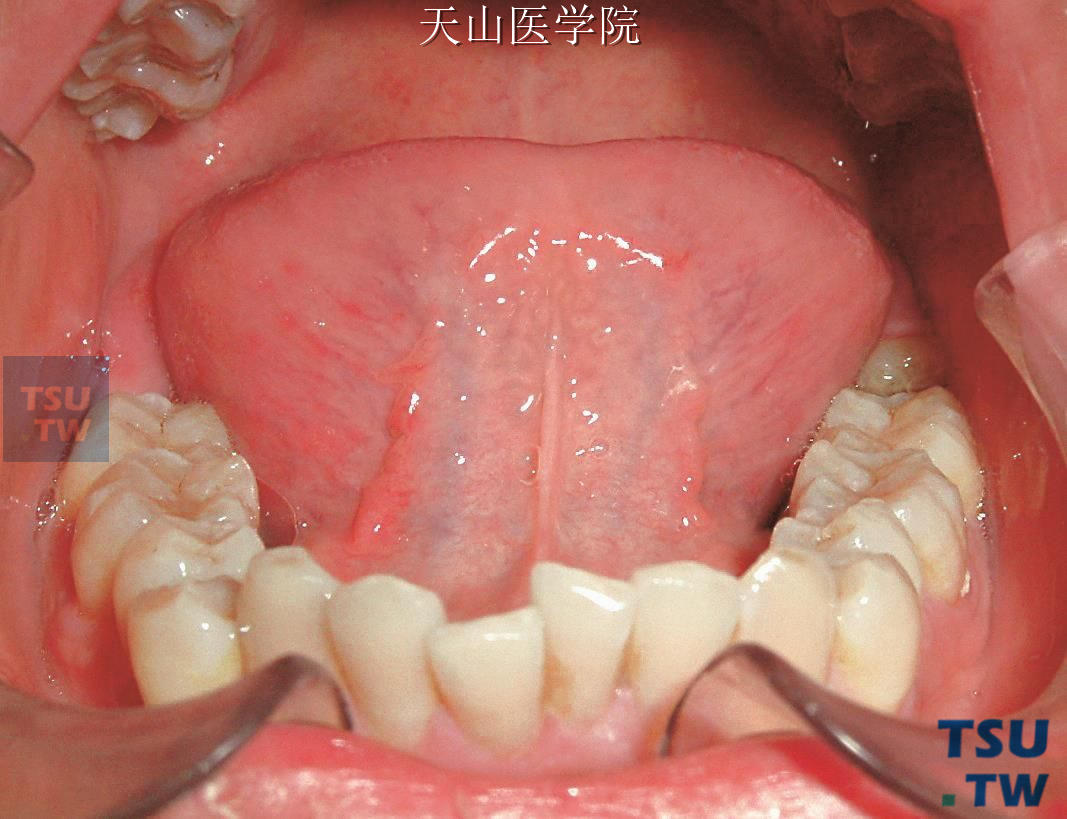 临床病例排齐整平前的下颌牙列