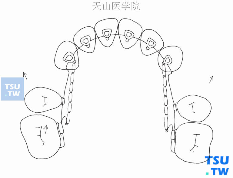 关闭间隙过程中的水平向弓形效应