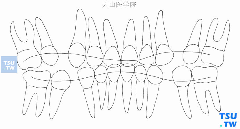 关闭间隙过程中的垂直向弓形效应