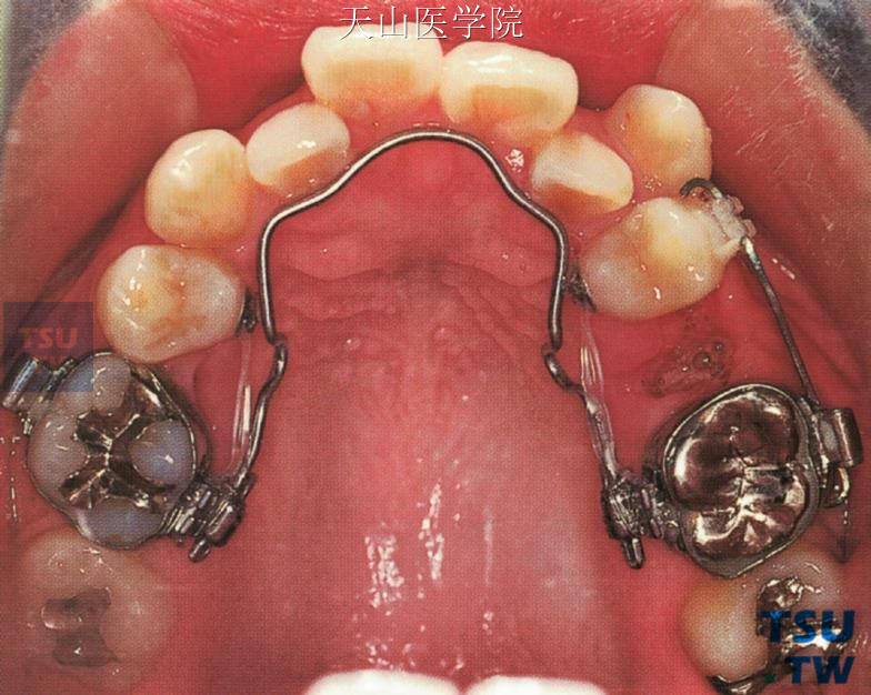 临床病例应用舌弓增强磨牙支抗，配合拉前磨牙后移