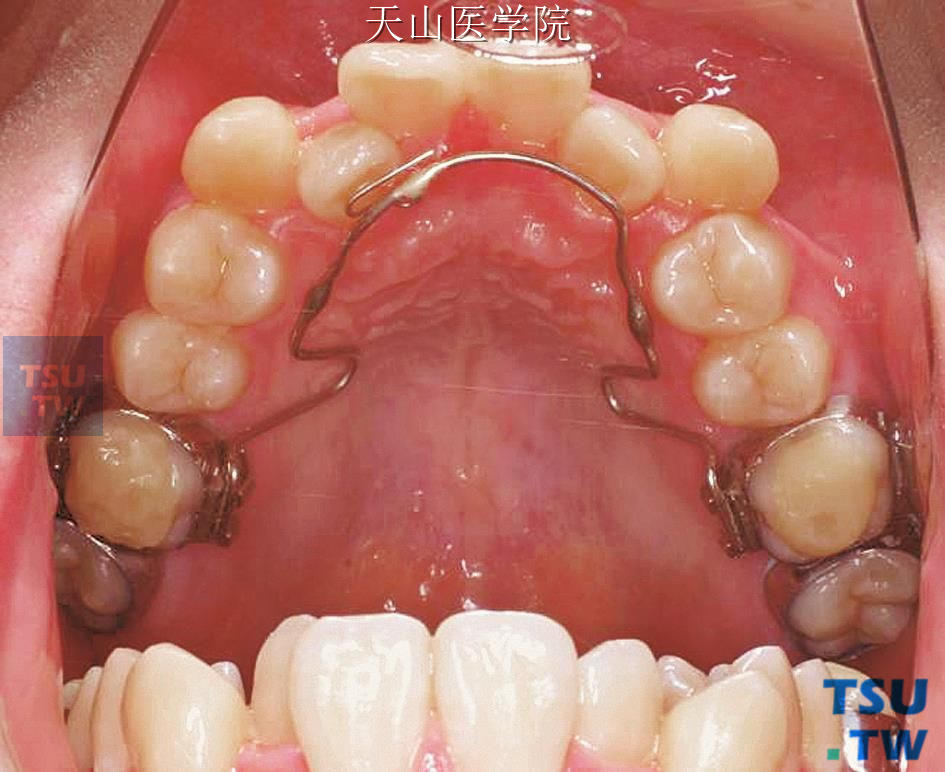 临床病例应用舌弓增强磨牙支抗，配合前牙扩弓