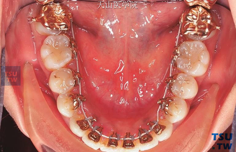 个性化舌侧矫治技术的终末弓丝为全尺寸的TMA方丝