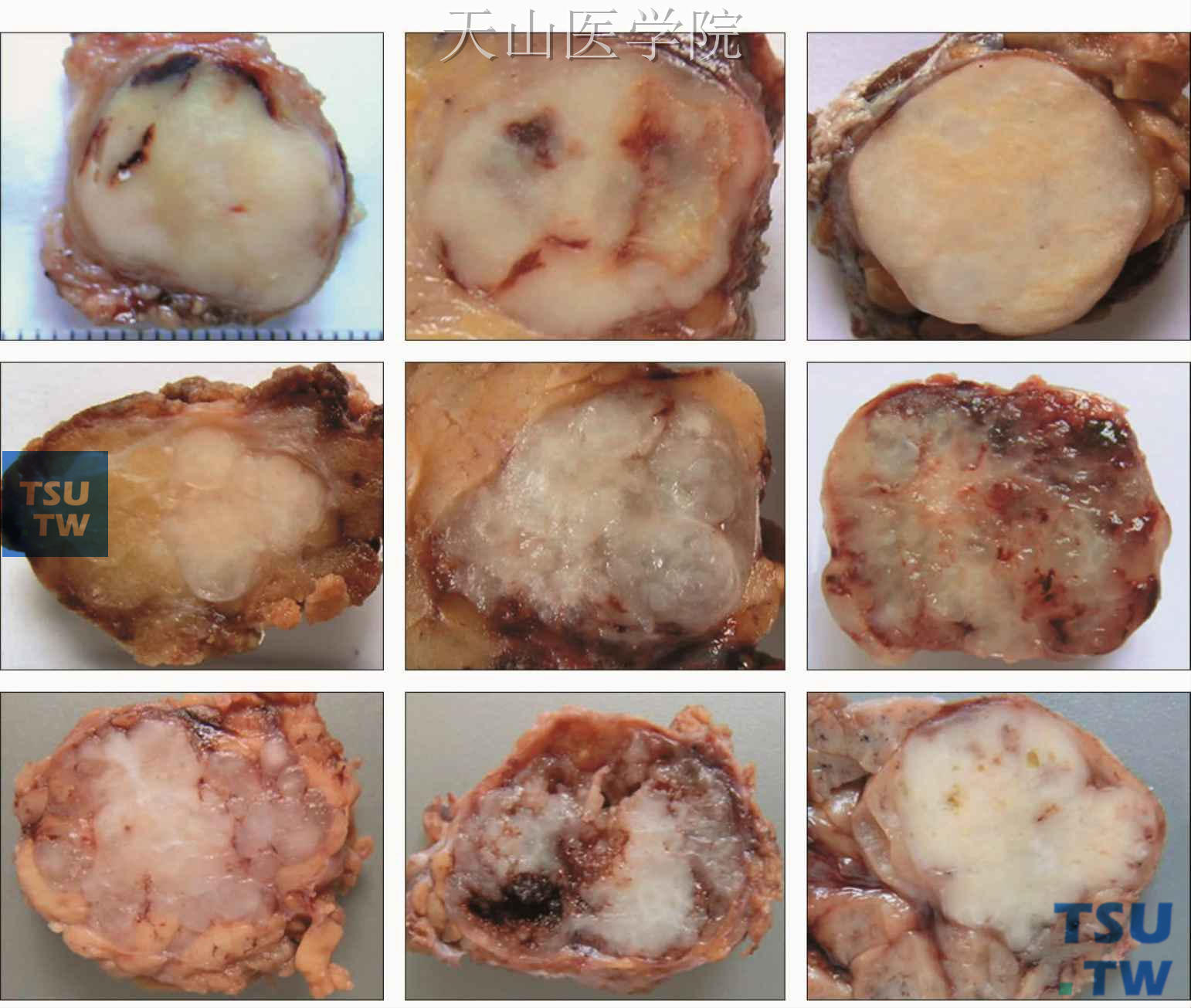 多形性腺瘤的剖面（罗海燕分切、摄影）