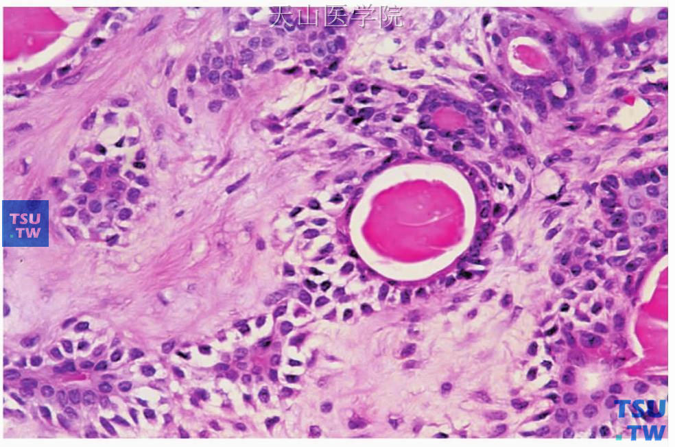 多形性腺瘤：肿瘤的腺上皮成分排列成单层导管结构，内含嗜酸性分泌物；导管外层为透明的肌上皮细胞，数量不等