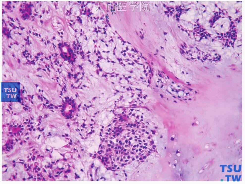 多形性腺瘤：肿瘤中的黏液样、软骨样组织穿插在上皮成分间