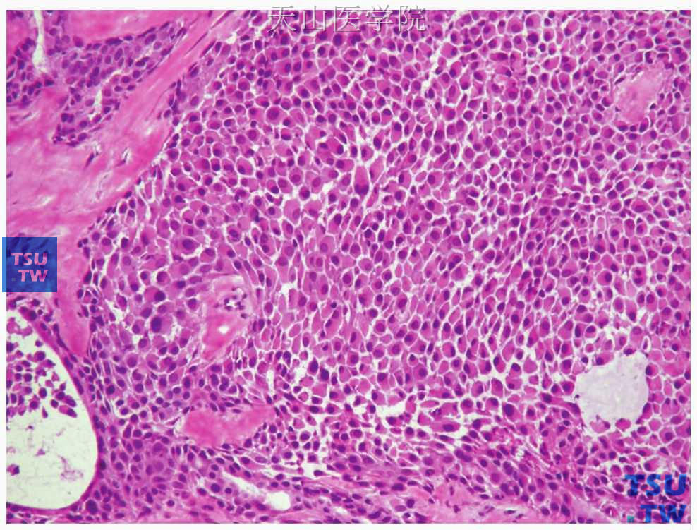 多形性腺瘤 ：浆样肌上皮细胞，胞质丰富，胞核位于细胞一侧