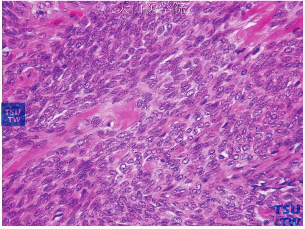 多形性腺瘤：梭形肌上皮细胞