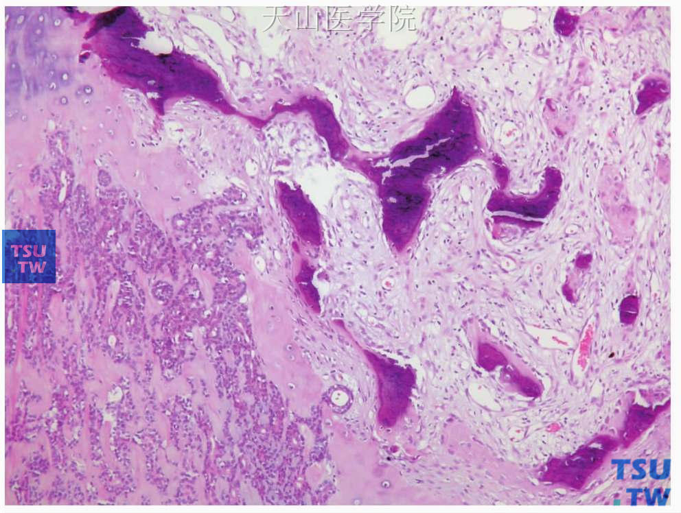多形性腺瘤：肿瘤中的骨组织，可能来自于软骨的骨化