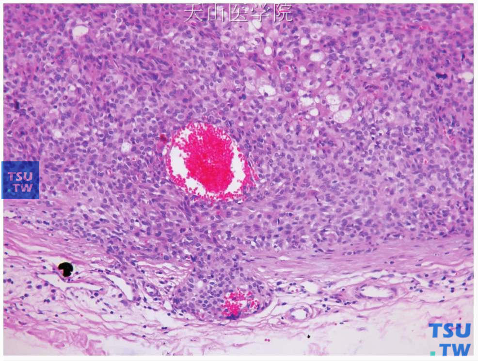 多形性腺瘤：肿瘤的包膜浸润，形成包膜内结节