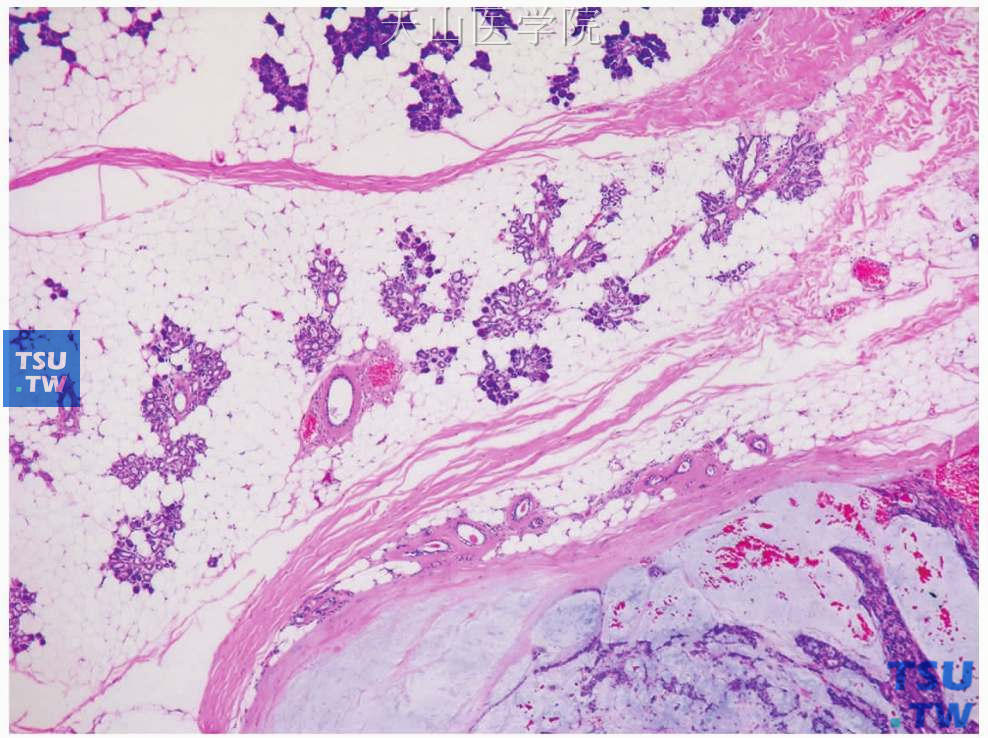 多形性腺瘤：肿瘤邻近的腺体见导管增生、腺泡萎缩
