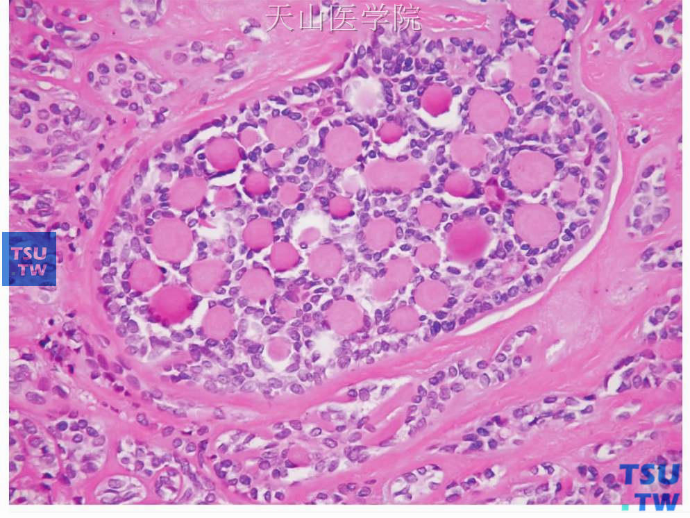 多形性腺瘤：肿瘤性肌上皮细胞形成较多细胞外物质，类似于腺样囊性癌