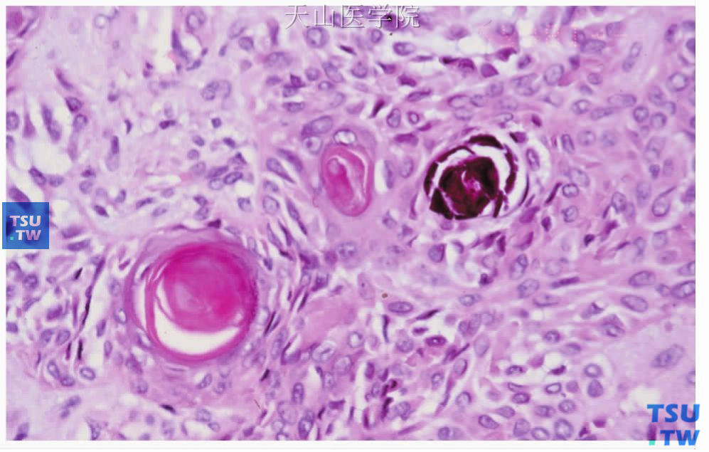 多形性腺瘤：肿瘤内的鳞状化生及钙化