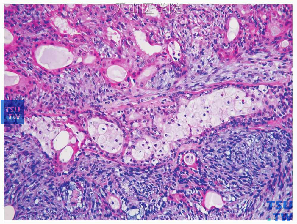  图7-16　多形性腺瘤  嗜酸细胞化生，见于图的上部分，可见顶浆分泌样表现；图的中部可见导管内含泡沫细胞，图的小部分为普通的多形性腺瘤表现的部分