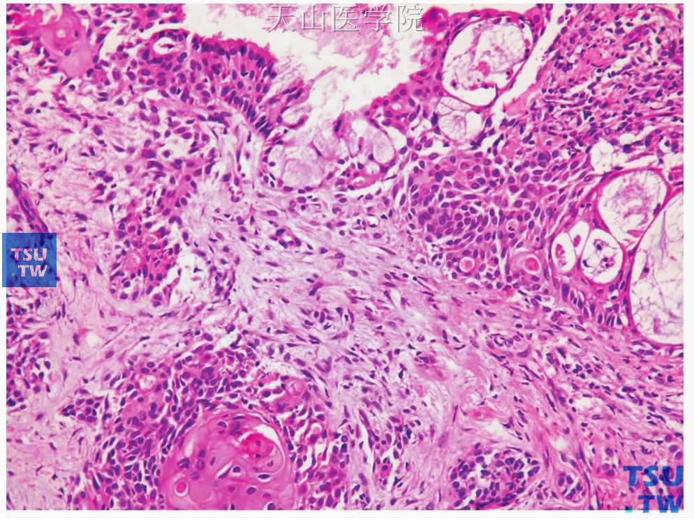 多形性腺瘤 ：肿瘤中出现局部黏液样细胞分化