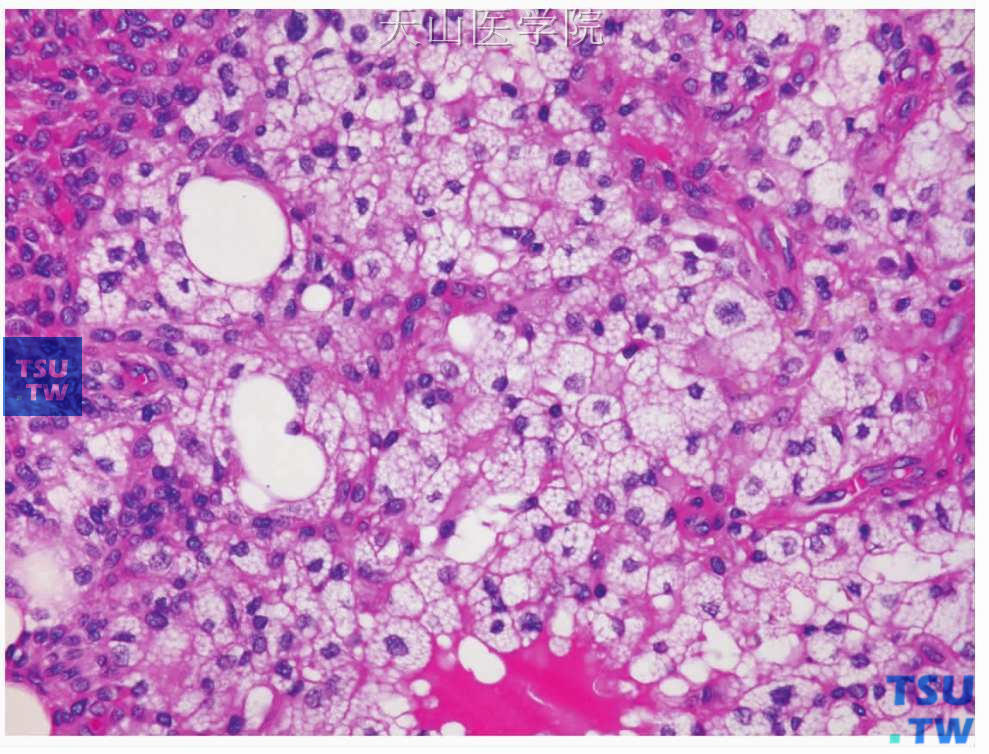 多形性腺瘤：  肿瘤中的皮脂样细胞