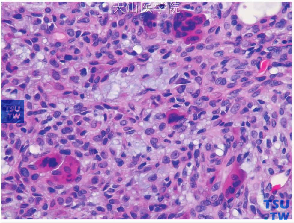 多形性腺瘤 ：肿瘤中的多核巨细胞