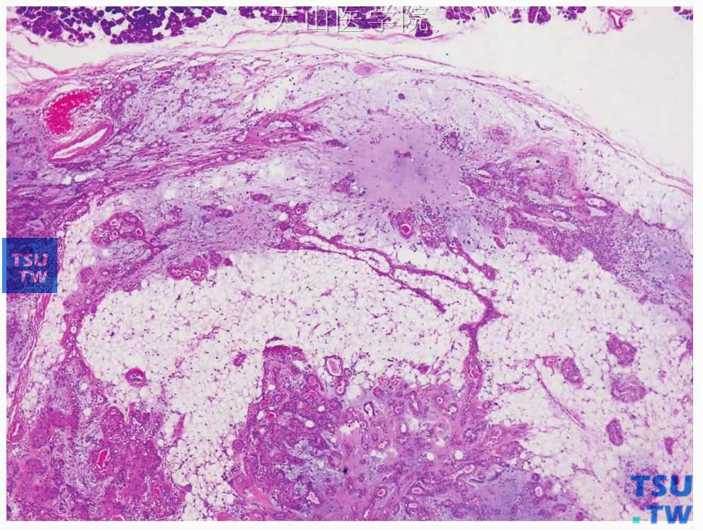 多形性腺瘤  ：含脂肪成分的多形性腺瘤
