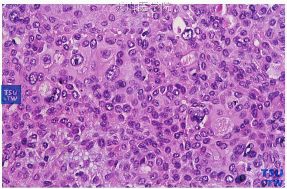 多形性腺瘤：肿瘤细胞出现多形性