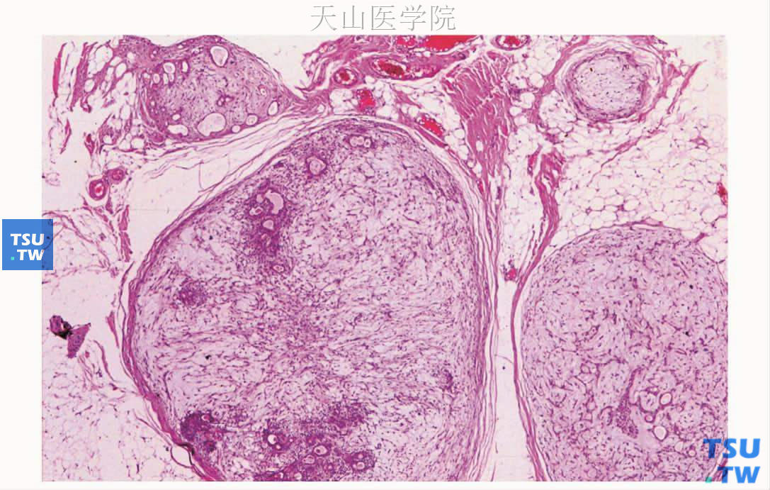 多形性腺瘤：肿瘤的种植性复发，多中心生长