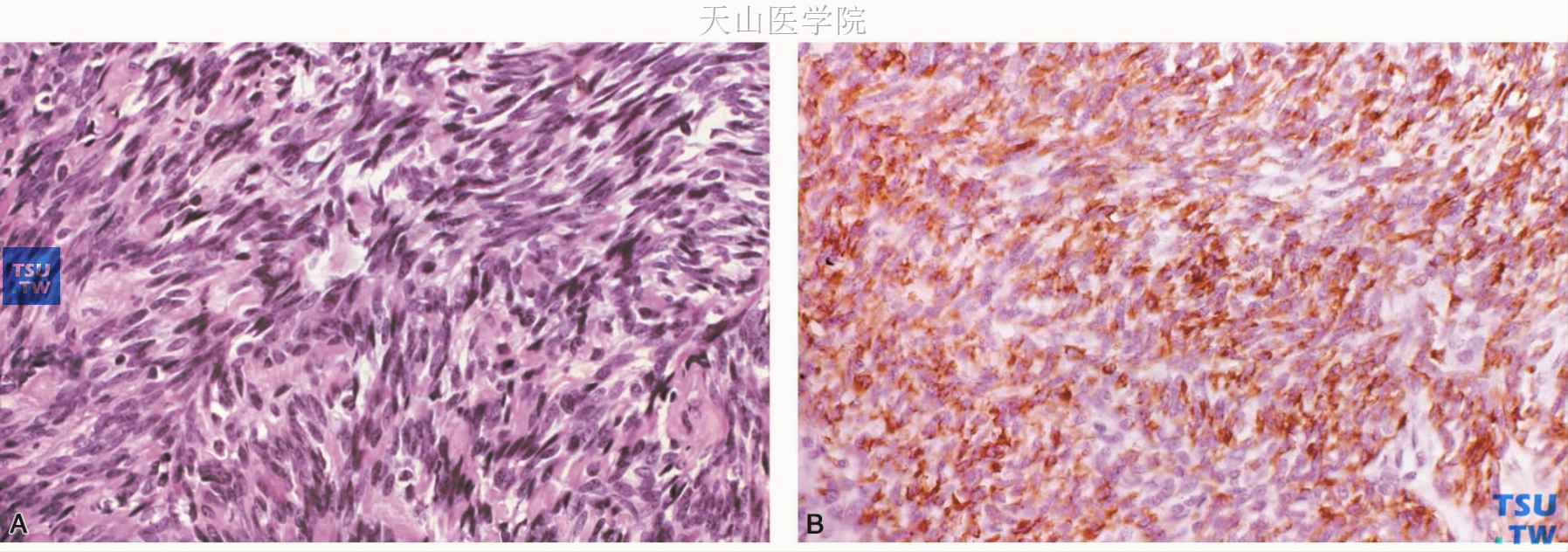 梭形细胞肌上皮瘤 A.细胞排列成束；B.肿瘤细胞表达肌动蛋白，免疫组化染色