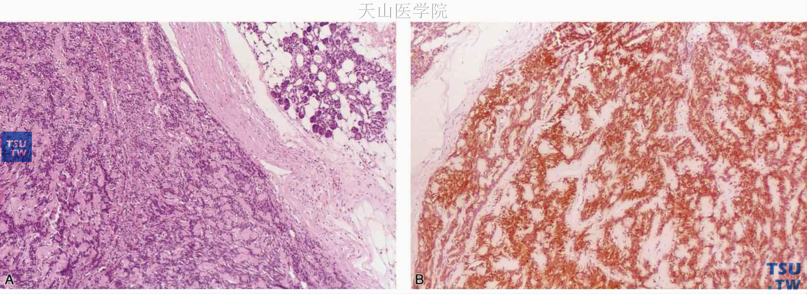 梭形细胞肌上皮瘤  A.肿瘤细胞排列类似于神经鞘瘤；B.肿瘤细胞表达肌动蛋白，免疫组化染色
