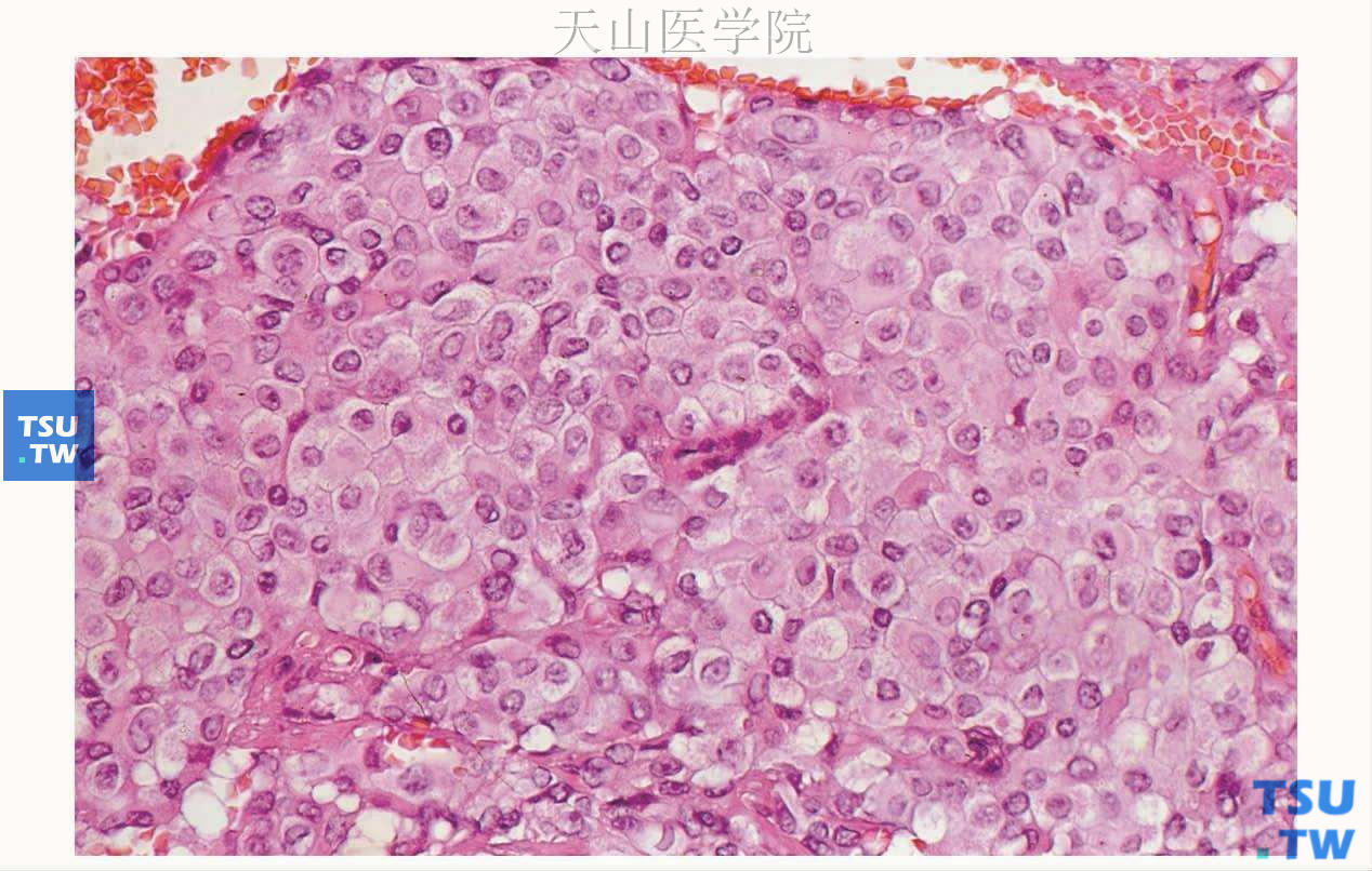 上皮样细胞肌上皮瘤：肿瘤细胞立方状，细胞核位于细胞中央