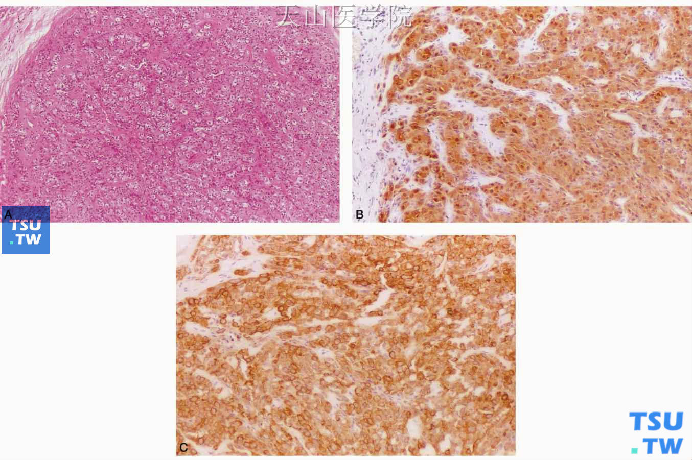 透明细胞肌上皮瘤  A.肿瘤细胞胞质透明；B.肿瘤细胞表达S100蛋白，免疫组化染色；C.肿瘤细胞表达细胞角蛋白，免疫组化染色