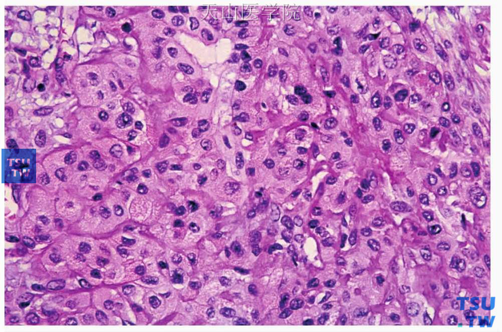 嗜酸细胞肌上皮瘤：肿瘤细胞胞质含嗜酸性颗粒，细胞具有轻度异型性