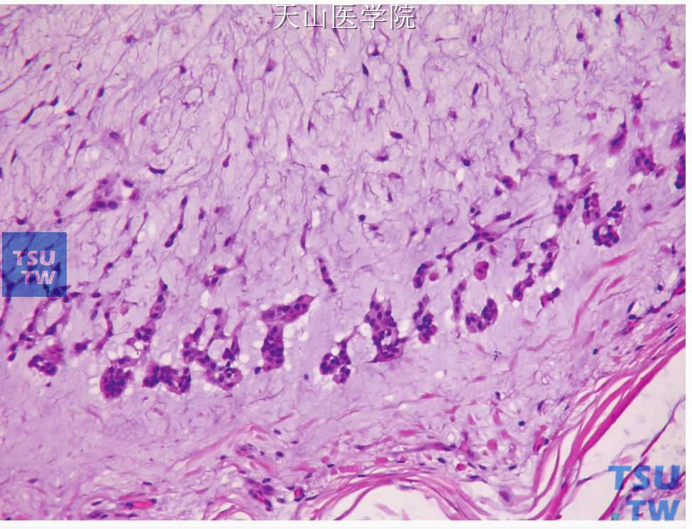 肌上皮瘤：伴丰富的黏液样间质