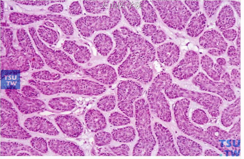 梁状型基底细胞腺瘤