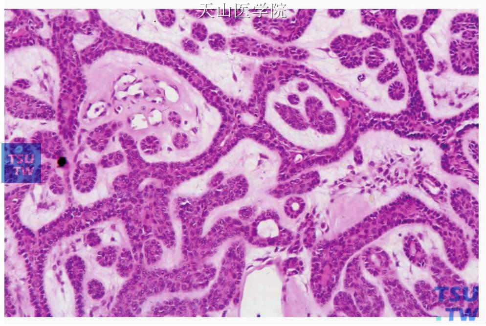 梁状型基底细胞腺瘤：肿瘤细胞形成的条索相互吻合