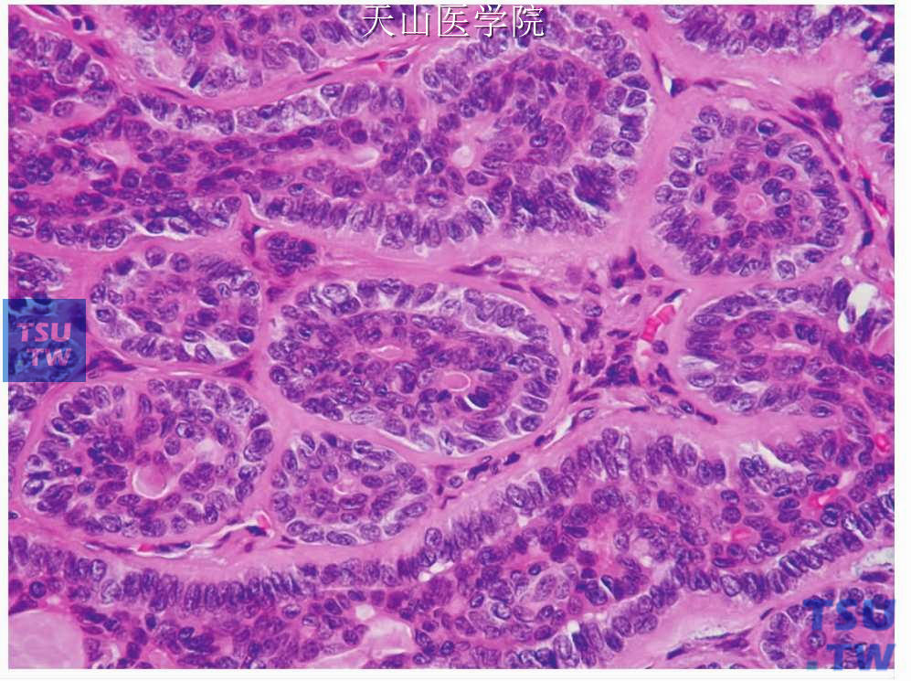 梁管状型基底细胞腺瘤：肿瘤细胞形成的小梁状结构中见导管分化