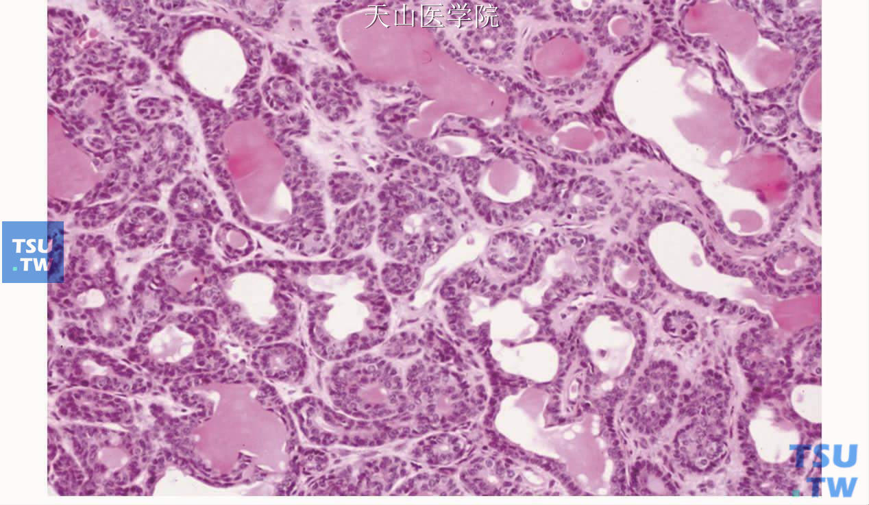 管状型基底细胞腺瘤：肿瘤细胞形成导管样结构