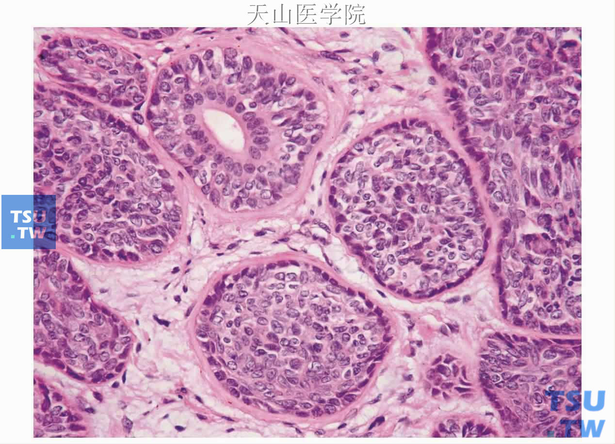 膜性型基底细胞腺瘤：肿瘤细胞团外围见较厚的基底膜